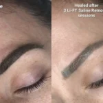 What Is the Best Eyebrow Tattoo Removal Method?