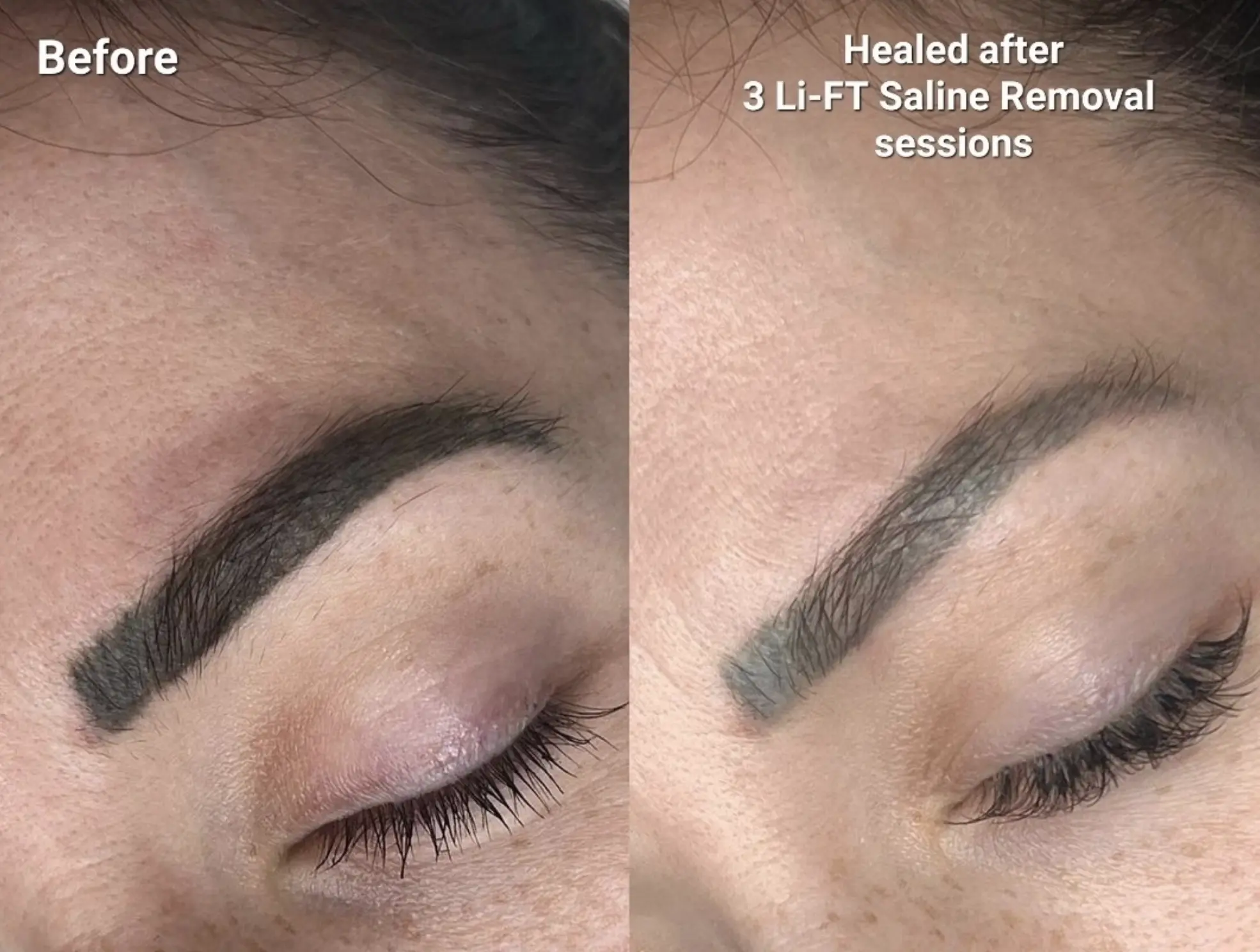 What is the best eyebrow tattoo removal method?